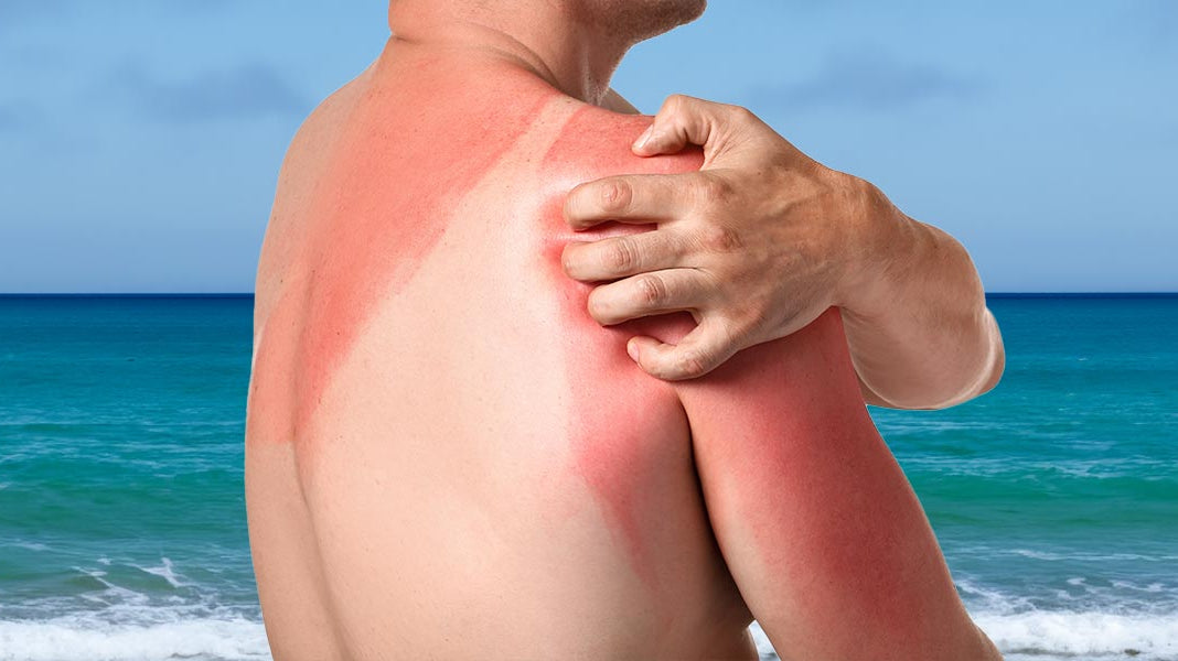 How to treat itchy sun rash? - Elliotti