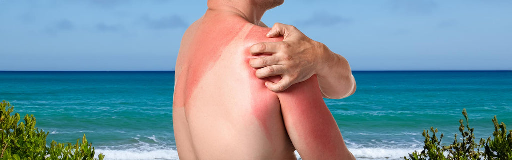 How to treat itchy sun rash? - Elliotti